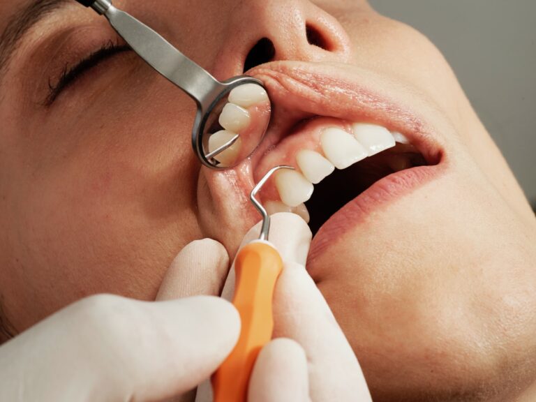 Post-Root Canal Care Instructions You Need to Know