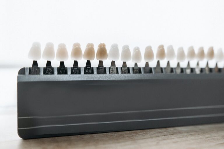 7 Advantageous Benefits of Dental Veneers over Other Methods