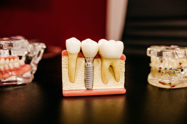 Watch Out for These Signs That You Need a Root Canal