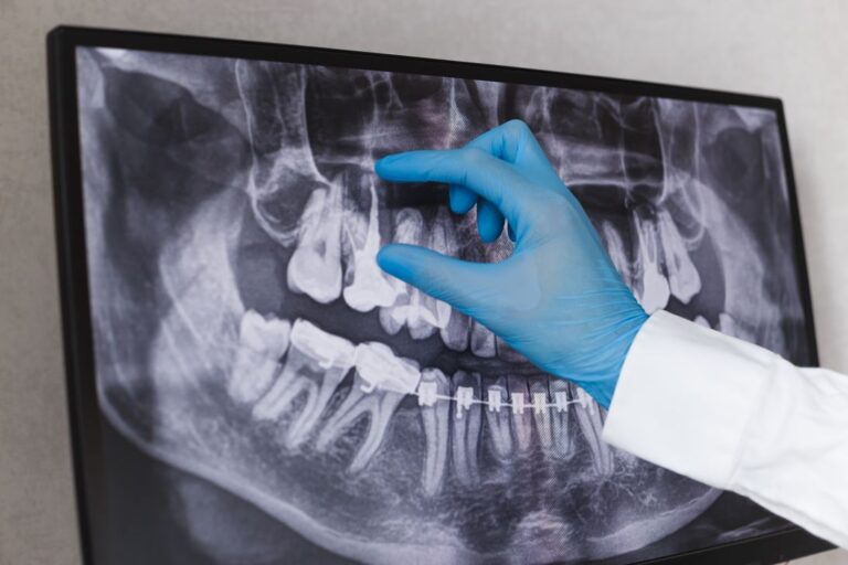 What to Expect from Your Upcoming Root Canal Procedure