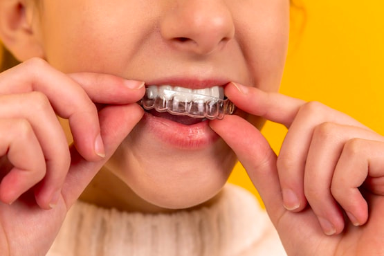 How Much Does Invisalign Cost in Sydney, Australia?