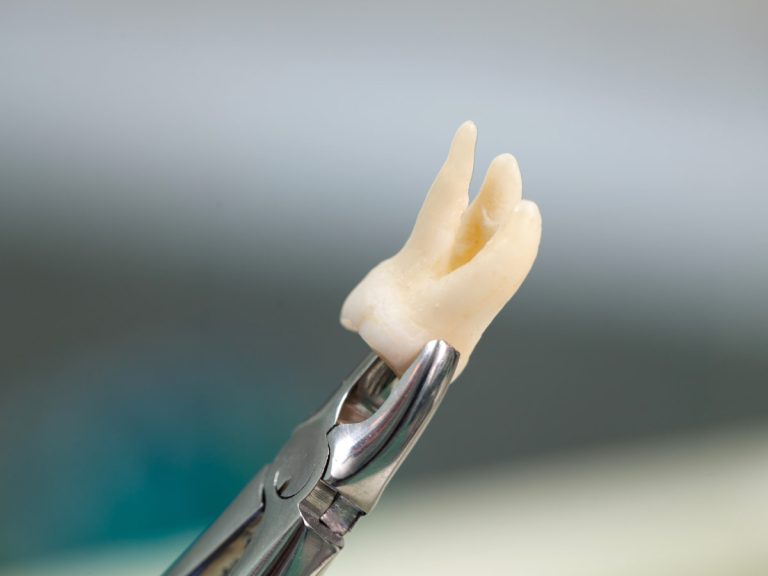 Tooth Extraction: When Is It Necessary?