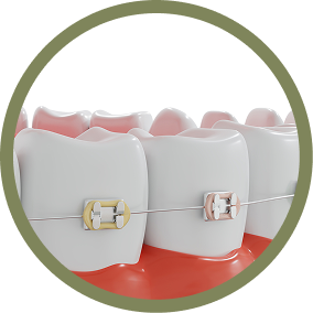 Metal Braces(also known as traditional braces)