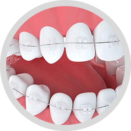 Ceramic Braces