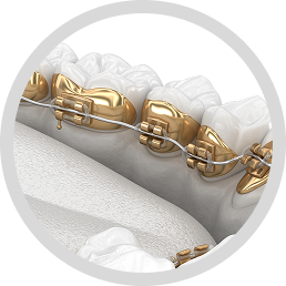 Lingual Braces