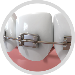 Self-ligating Braces