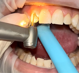 Tooth Preparation