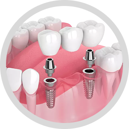 Implant-Supported bridges
