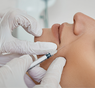 Nasolabial Fold Filler