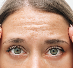 Forehead lines