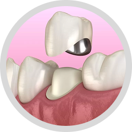 Porcelain fused to metal (PMF)