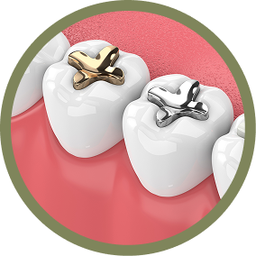 Amalgam fillings