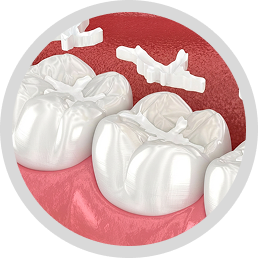 Ceramic fillings