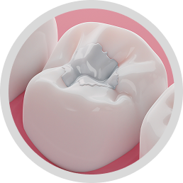 Composite fillings