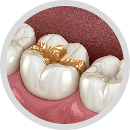 Gold fillings