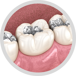 Metal fillings