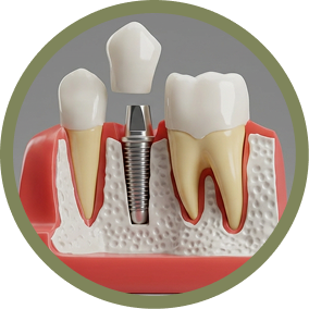 Endosteal Implant (Single)