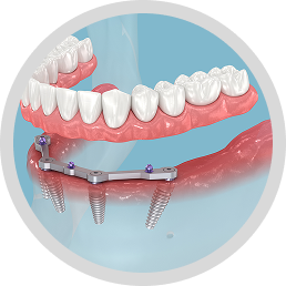All-On-4 Dental Implants