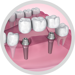 Dental Implant-supported Bridge