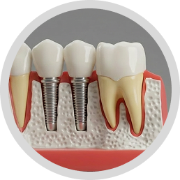 Subperiosteal Dental Implant