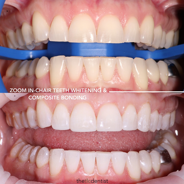 Composite Bonding