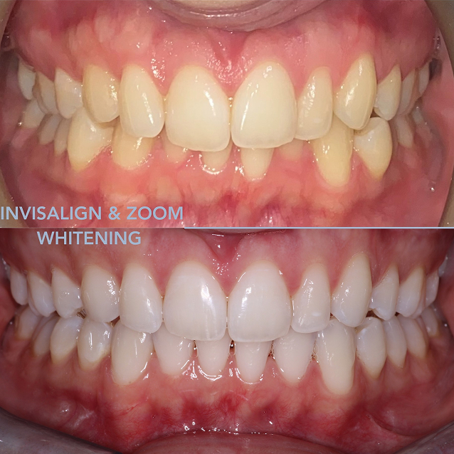 Invisalign + Whitening