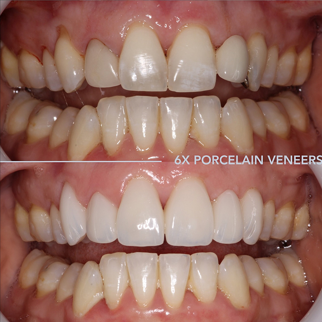Porcelain Veneers