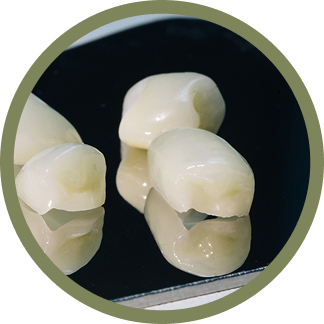 Composite Veneers: